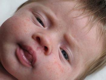 Dermatitis in the baby: the causes and ways of treatment