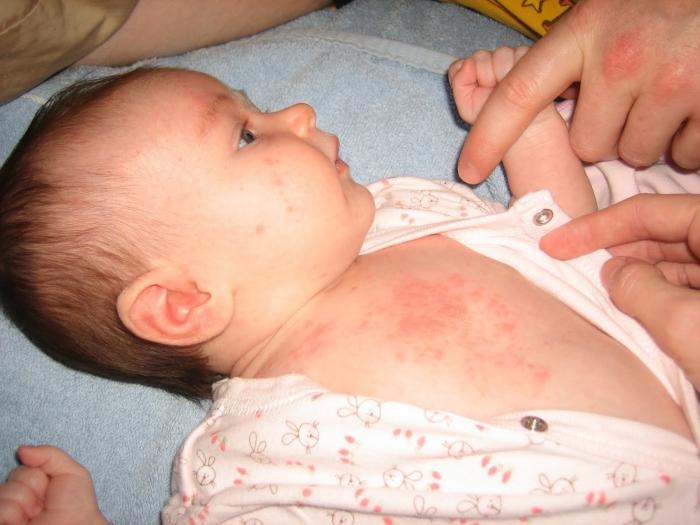 treatment of swabbing in newborns