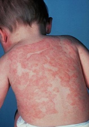 The most common skin diseases in a child