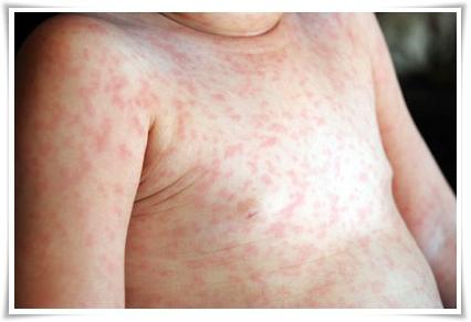 Rashes in the child all over the body. What to do?