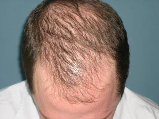 Hair loss in children