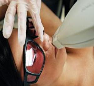 Laser epilation of the upper lip: an effective procedure in the fight against bored hairs