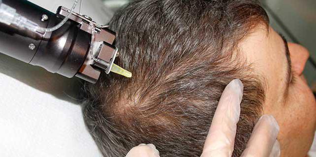 fractional mesotherapy of the scalp