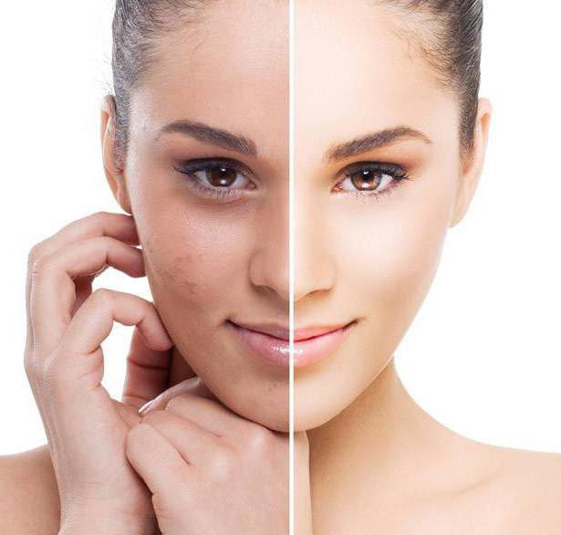 Types of peeling for the face in cosmetology