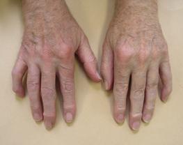 arthrosis of the hands symptoms 