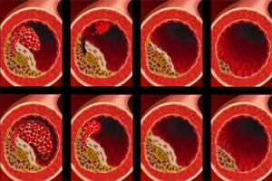 arteriosclerosis