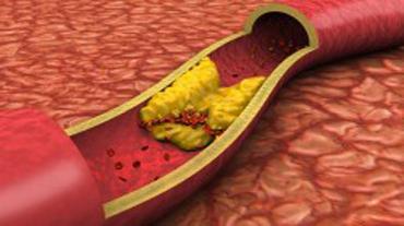 atherosclerosis of the vessels of the neck