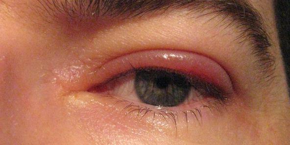 blepharitis treatment at home reviews