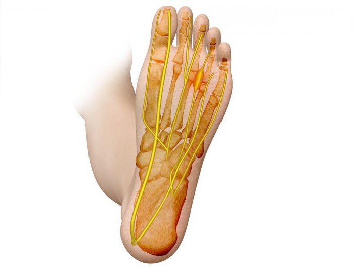 Pain in the foot under the fingers when walking than to treat folk remedies 