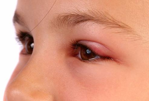 If your child has swollen eyes - do not hesitate!