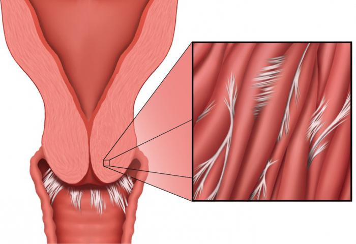 after hysteroresectoscopy