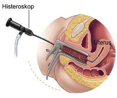 Hysteroresectoscopy - what is it? Minimally invasive method of treatment of gynecological diseases