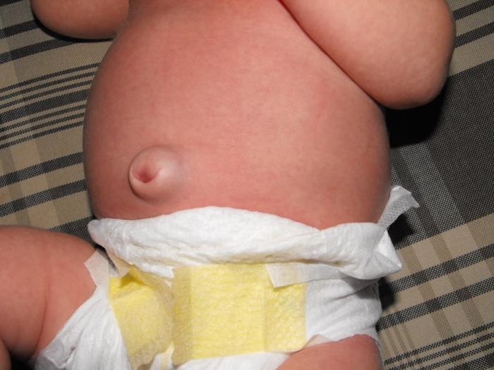 hernia in newborns photo