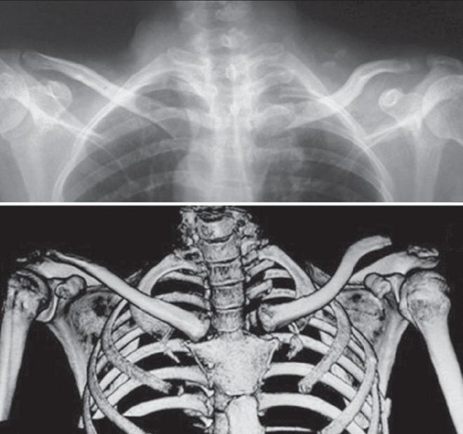 sternoclavicular joint