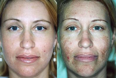 Chemical face peeling. Description, types of procedures