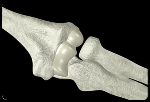 chondroprotectors for osteochondrosis