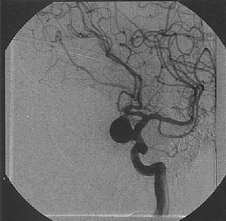 Stroke. Symptoms and Treatment