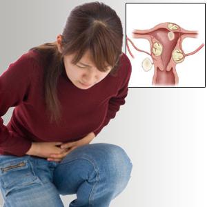 How to treat myoma of the uterus without surgery: methods, reviews