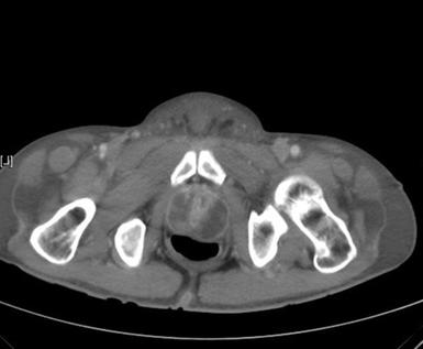 acute prostatitis treatment