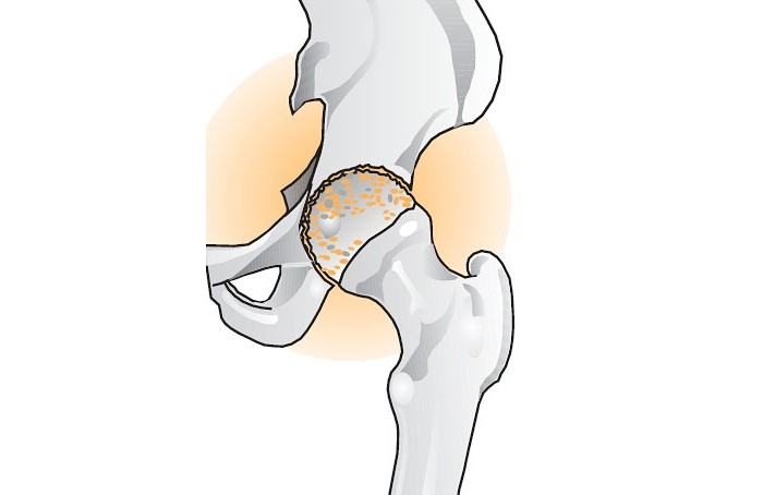 How to treat coxarthrosis with folk remedies?