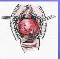 degree of uterine prolapse