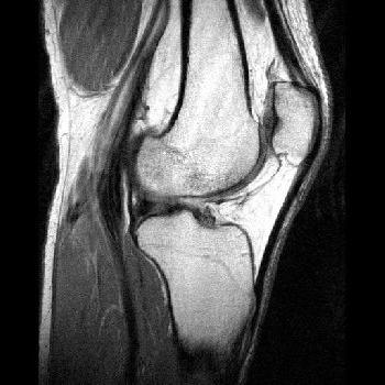 Knee and MRI