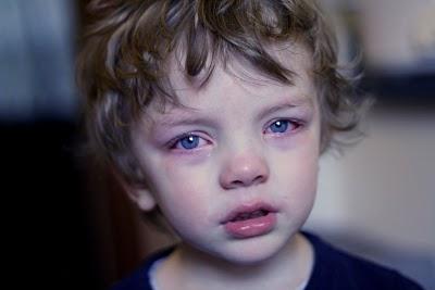 Red eyes in a child: causes, treatment and prevention