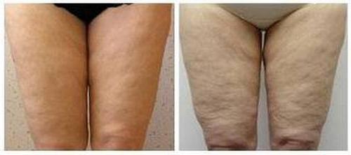 Mesotherapy for losing weight at home