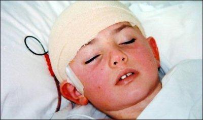 How serious are the effects of meningitis in children?