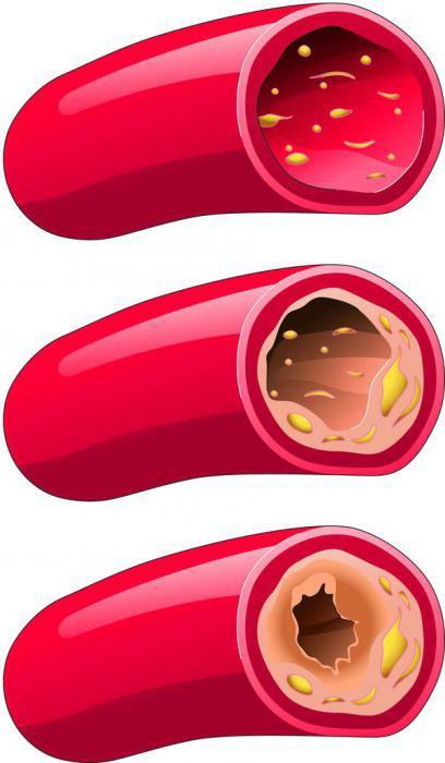 non-stenotic atherosclerosis of extracranial brachiocephalic arteries