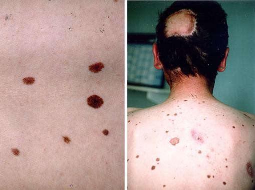  papillomatous nevus