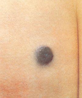 after nevus removal