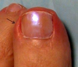 The nail grew into a finger: the causes and treatment