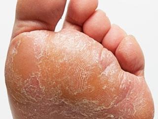 The main symptoms of foot fungus