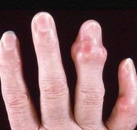 The main symptoms of rheumatoid arthritis