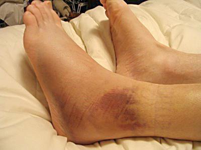 rupture of ligaments of the ankle