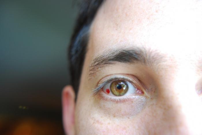 Why do the eyes burst blood vessels: the causes and treatment