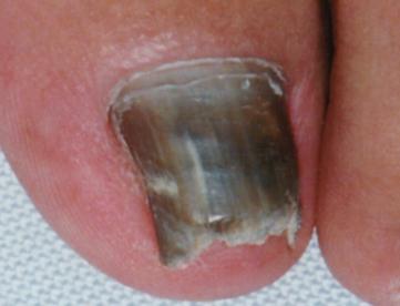 onychomycosis nail treatment