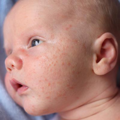 pimples on the body of a child