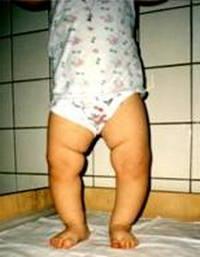 Rickets in infants: signs and manifestations