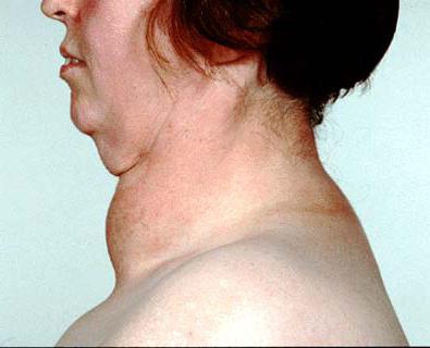 hyperthyroidism is