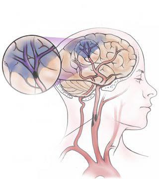 Ischemic stroke