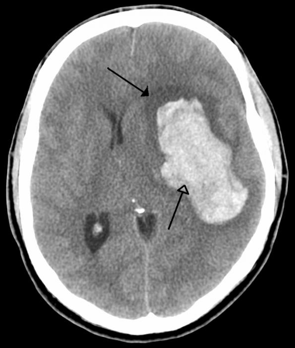 Extensive ischemic stroke