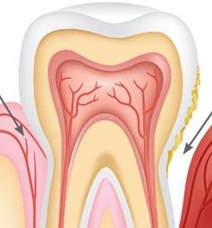 symptoms of periodontitis