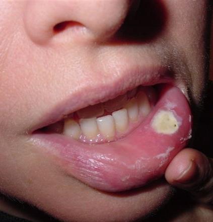 Symptoms of Lip Cancer - How to recognize them?