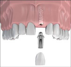 How much does one tooth implant cost in modern clinics?