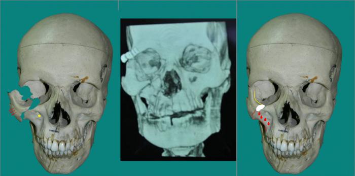 Cheekbone. The temporal process of the zygomatic bone