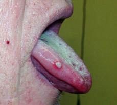 Stomatitis - treatment in adults