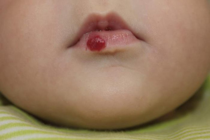 hemangioma on the lips 