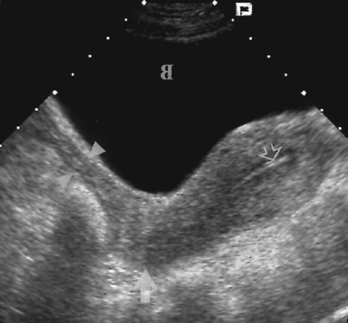 Thickness of endometrium: norm and value